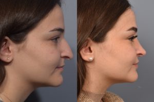 patient before and after rhinoplasty