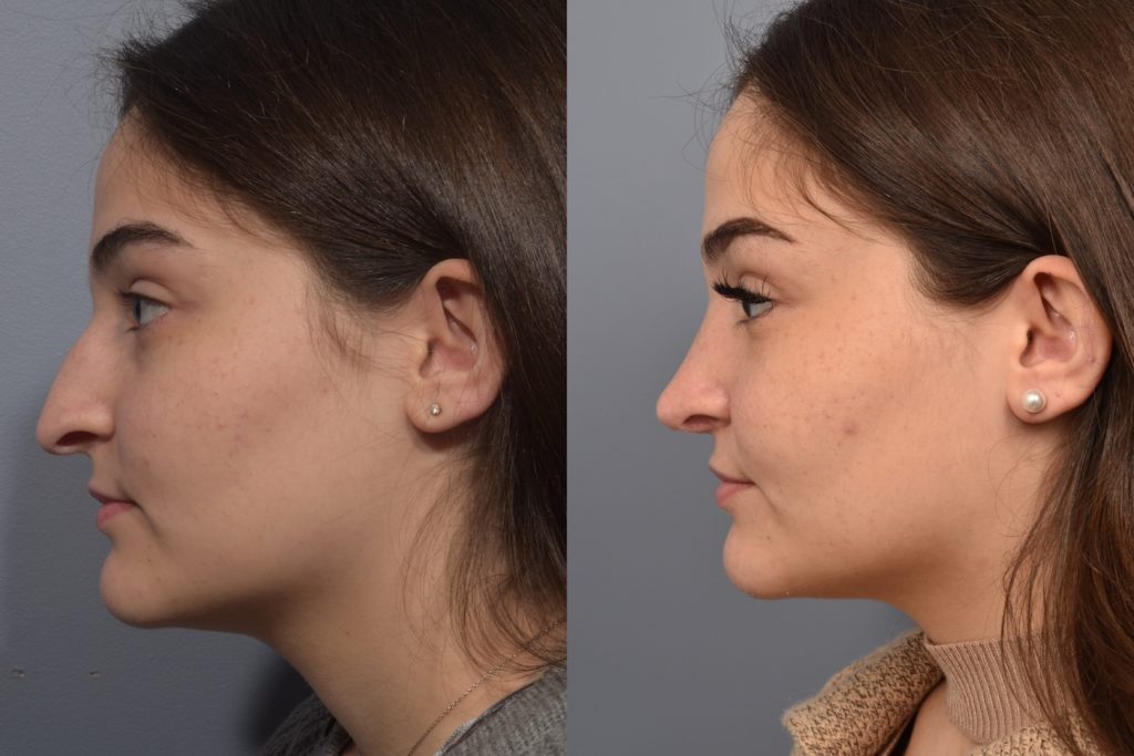 patient before and after rhinoplasty
