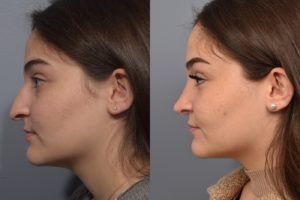 patient before and after rhinoplasty