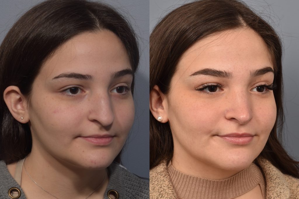 patient before and after rhinoplasty