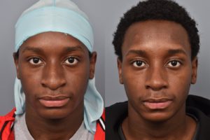 patient before and after rhinoplasty