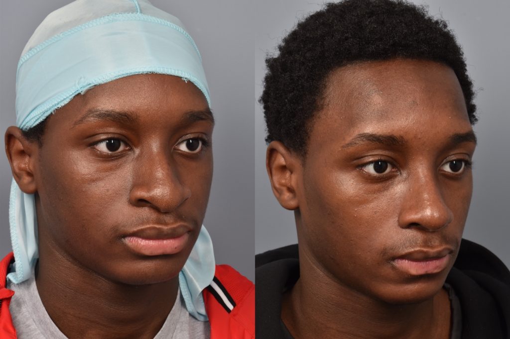 patient before and after rhinoplasty
