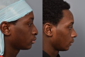 patient before and after rhinoplasty