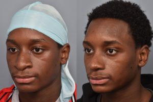 patient before and after rhinoplasty