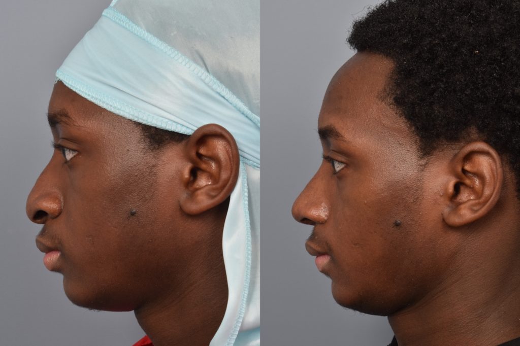 patient before and after rhinoplasty