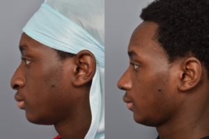 patient before and after rhinoplasty
