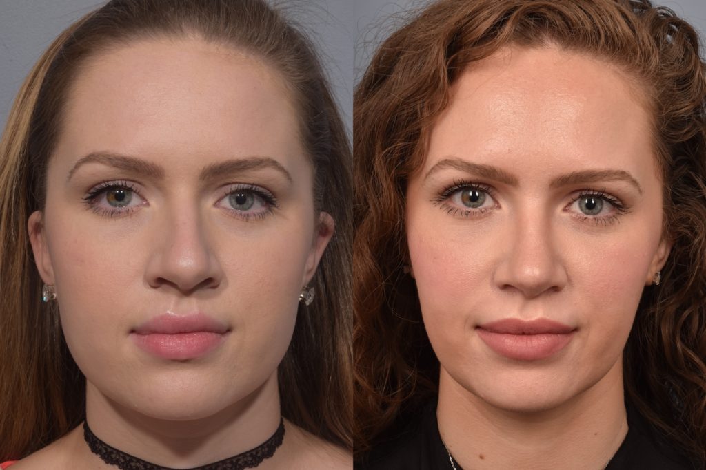 patient before and after rhinoplasty