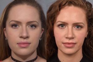 patient before and after rhinoplasty