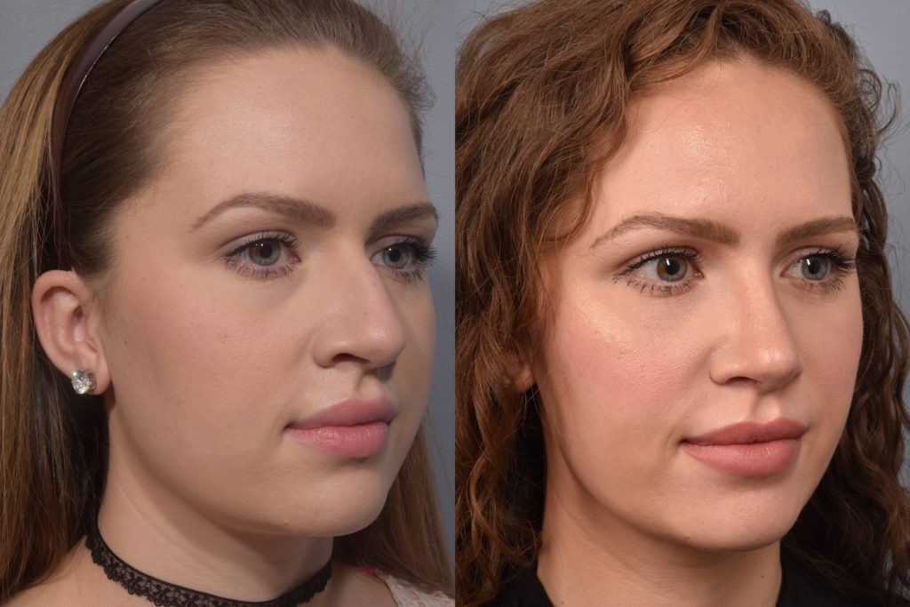 patient before and after rhinoplasty