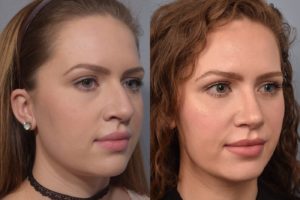 patient before and after rhinoplasty