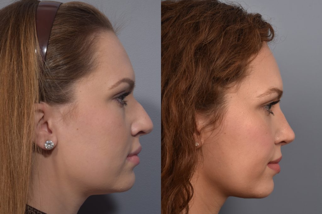 patient before and after rhinoplasty
