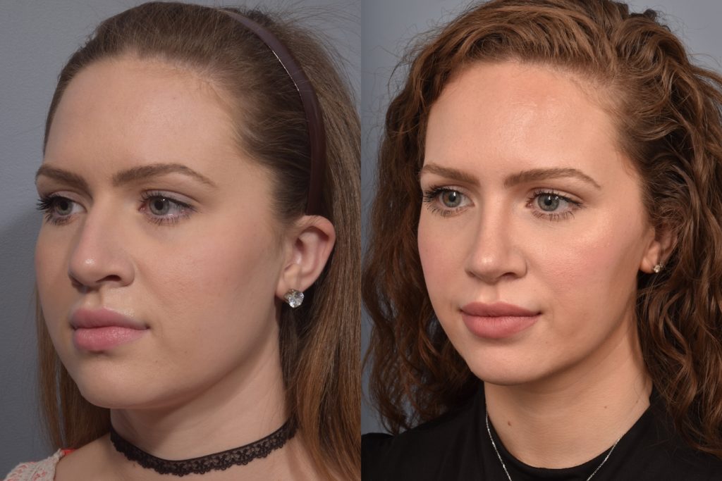 patient before and after rhinoplasty