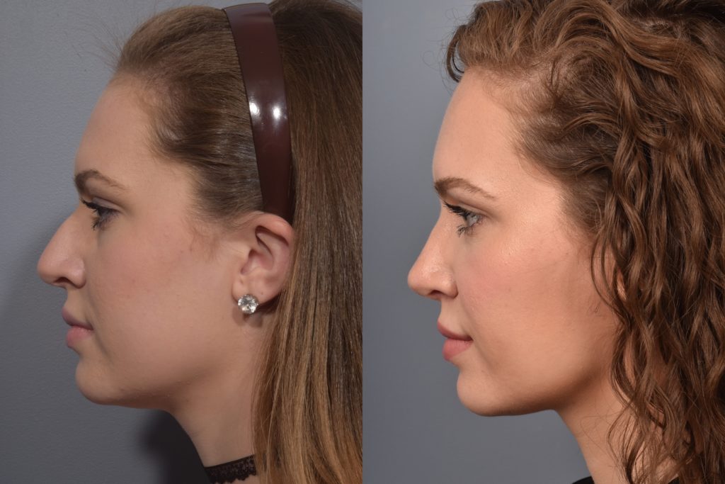 patient before and after rhinoplasty