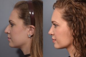patient before and after rhinoplasty