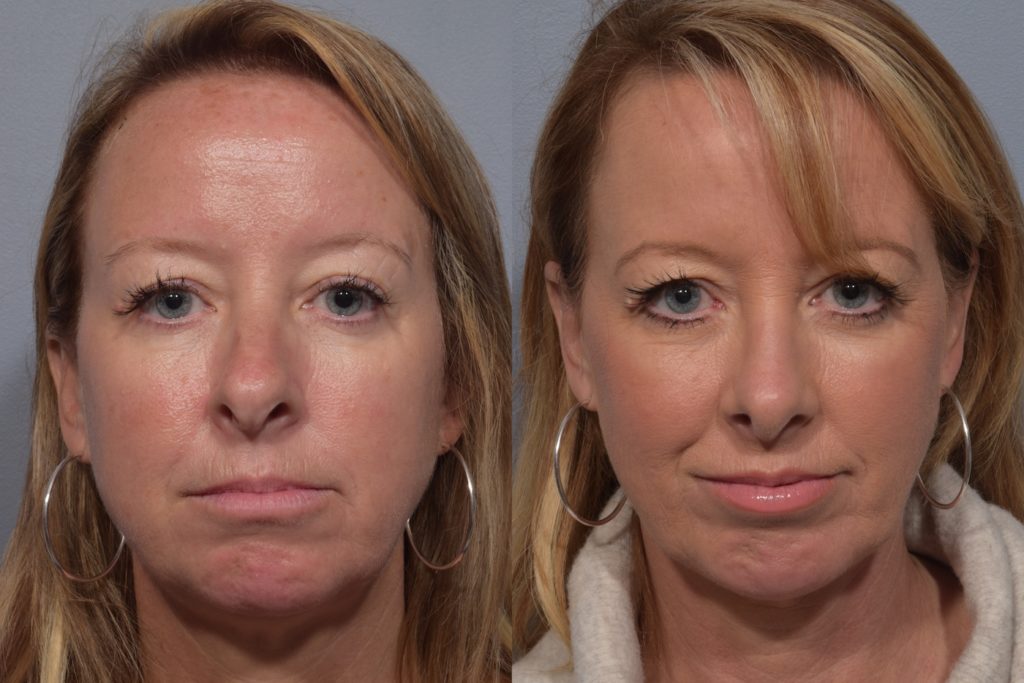 patient before and after septoplasty