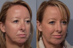 patient before and after septoplasty