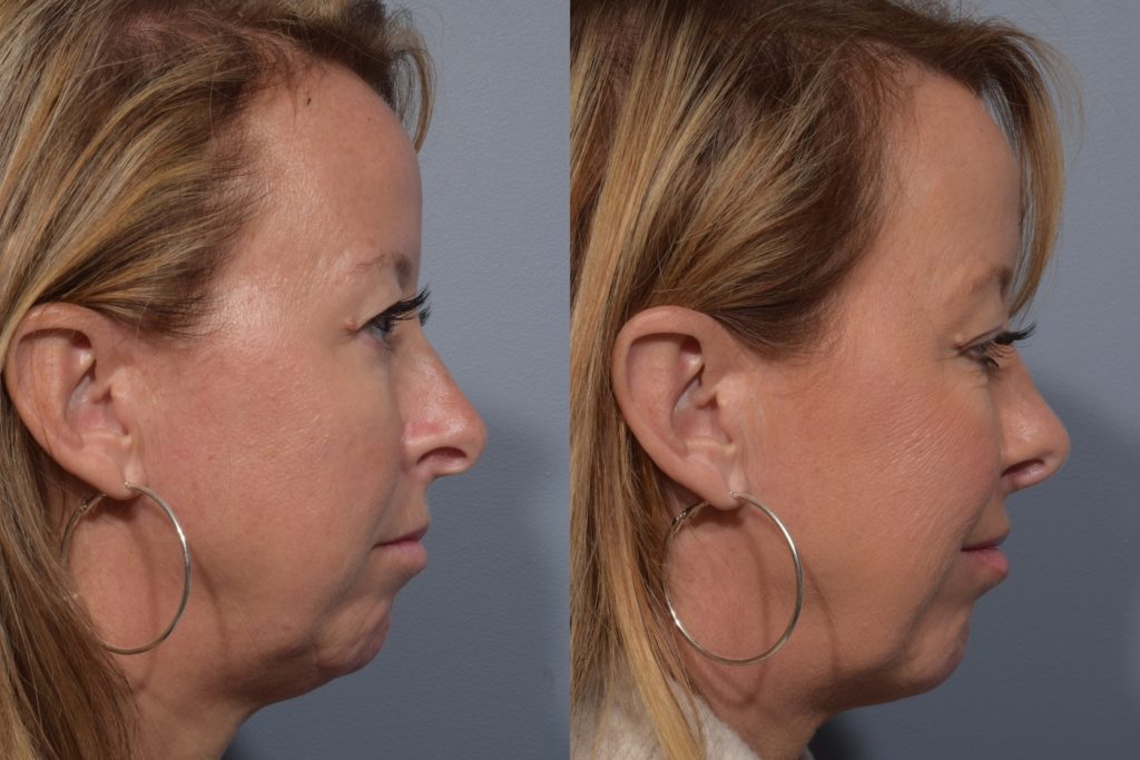 patient before and after septoplasty