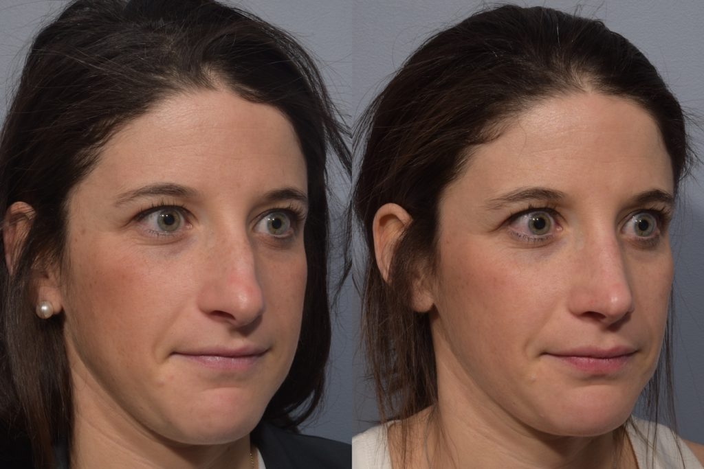 patient before and after septoplasty