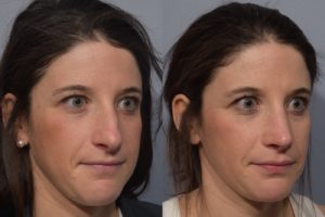 patient before and after septoplasty