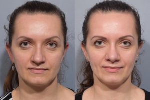 patient before and after septoplasty