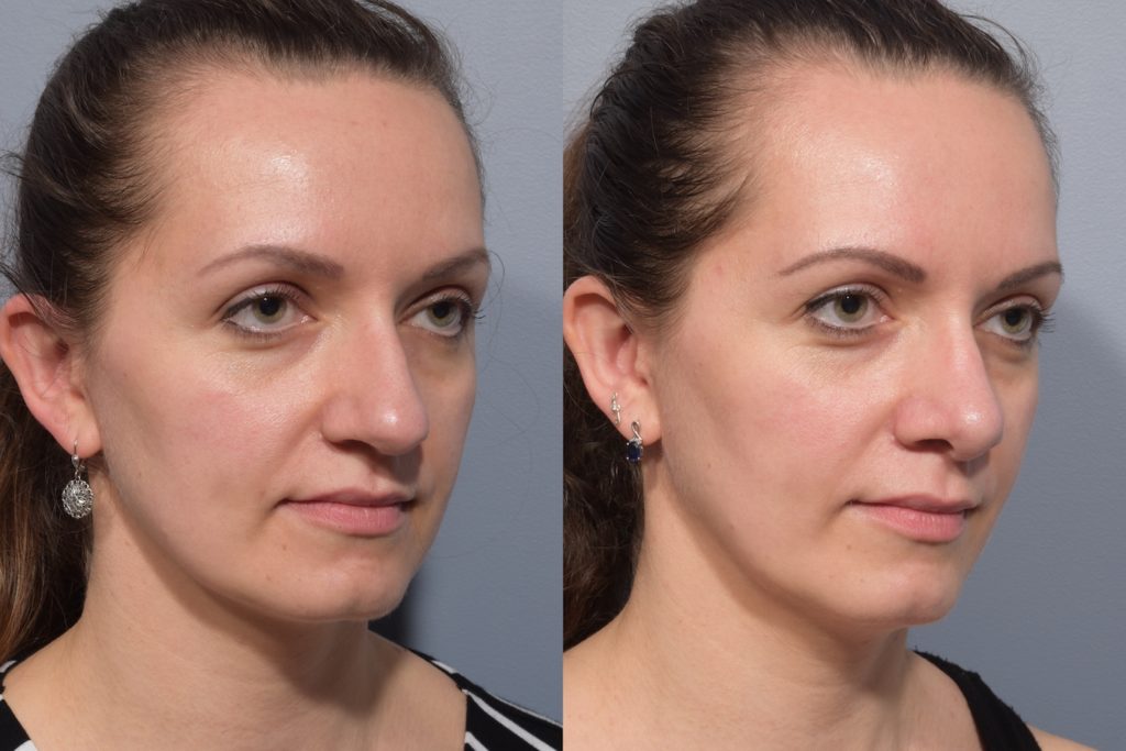 patient before and after septoplasty