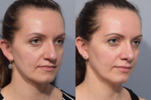 patient before and after septoplasty