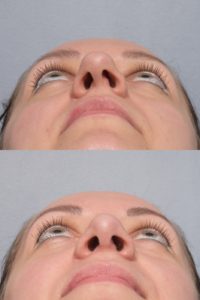 patient before and after septoplasty