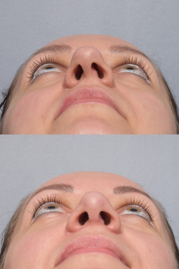 patient before and after septoplasty