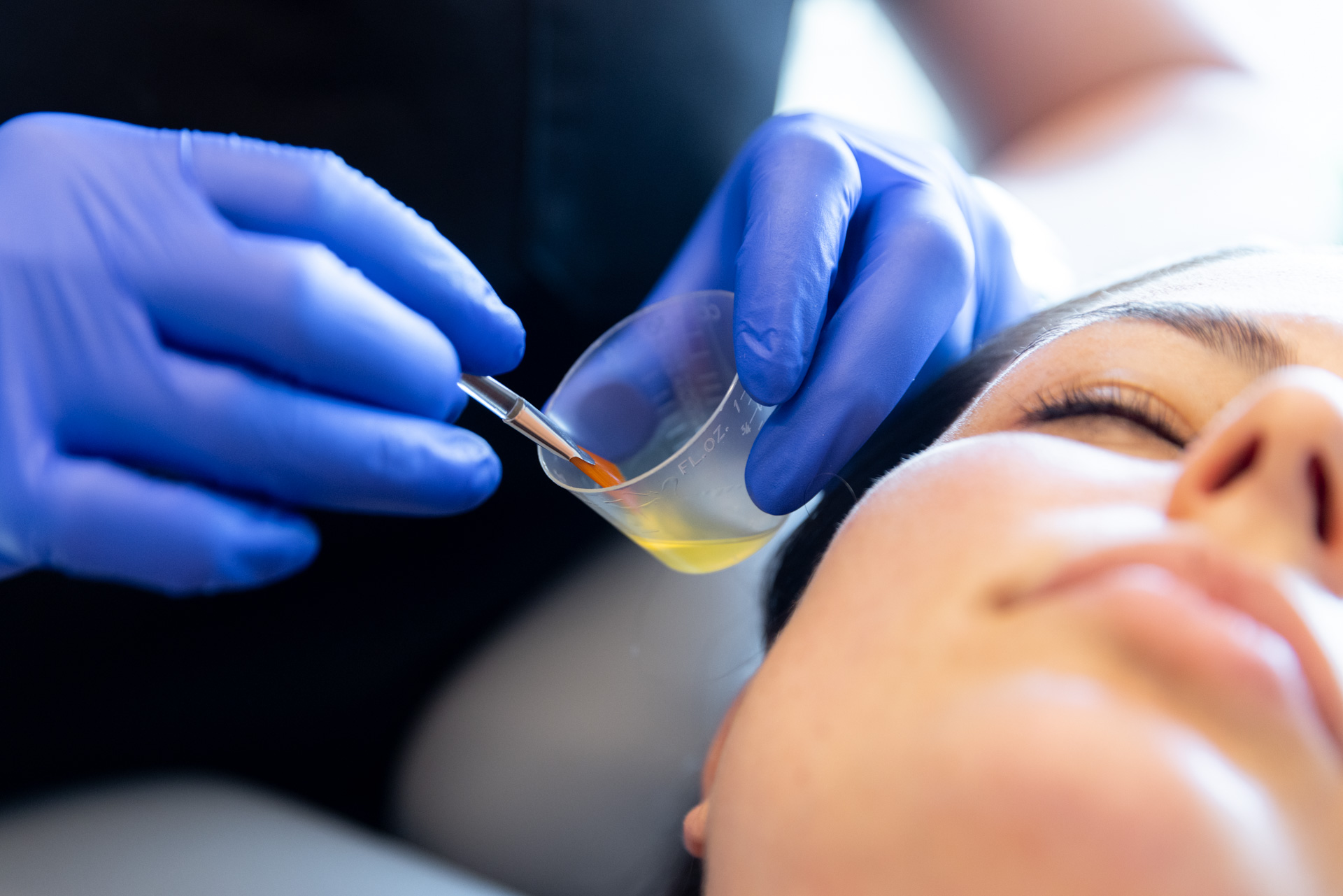 applying chemical peel solution to woman's face with brush