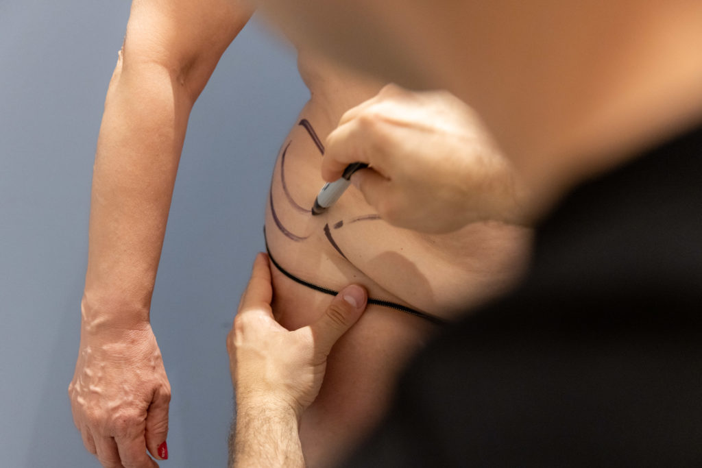 Dr. Stein Surgical Consultation drawn on patient's waist