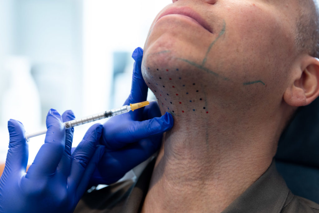 Kybella close up injection to the patient's lower chin