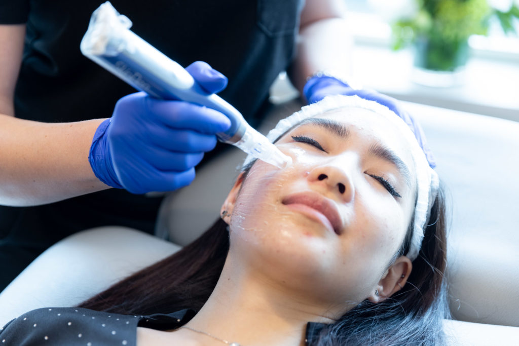 Microneedling device being used on patient