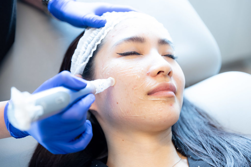 Microneedling treatment on patient