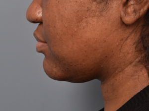 patient before Kybella