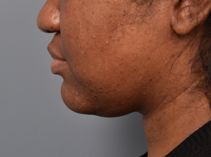 patient before Kybella