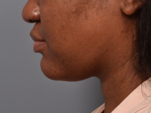 patient after Kybella
