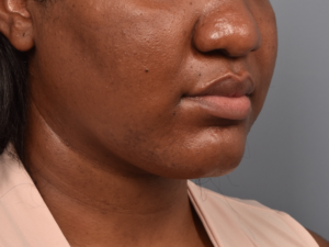 patient after Kybella
