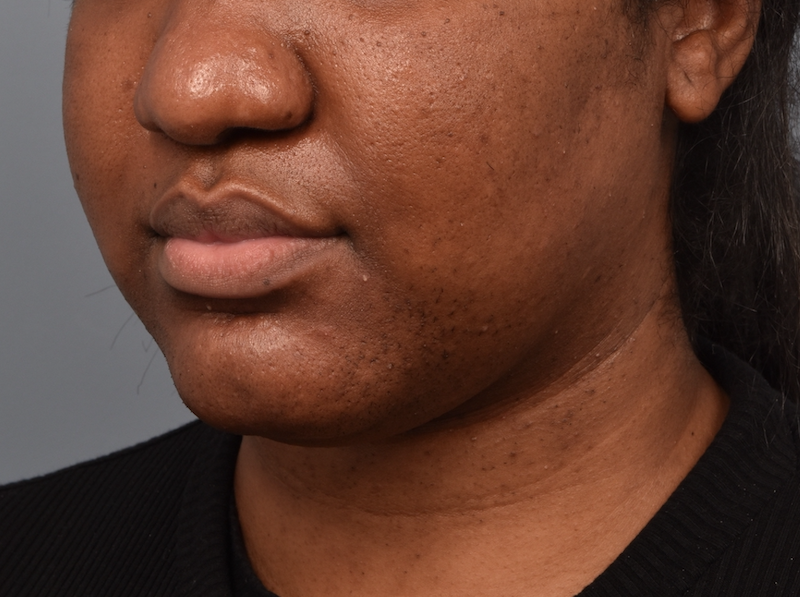 patient before Kybella