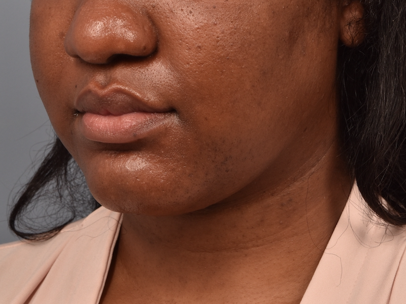 patient after Kybella