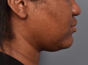 patient before Kybella