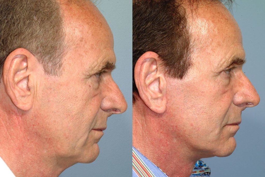 patient before and after facelift