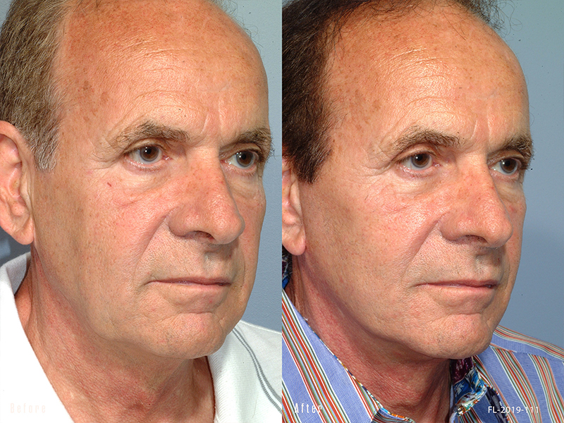patient before and after facelift