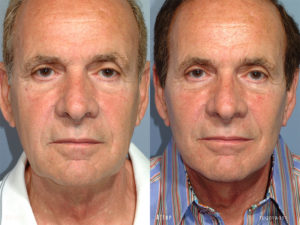 patient before and after facelift