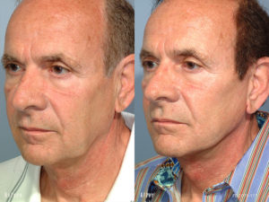 patient before and after facelift