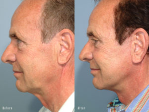 patient before and after facelift