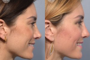 patient before and after revision rhinoplasty