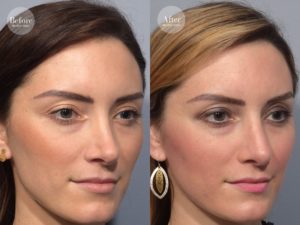 patient before and after revision rhinoplasty