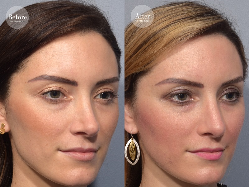 patient before and after revision rhinoplasty