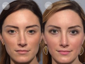 patient before and after revision rhinoplasty