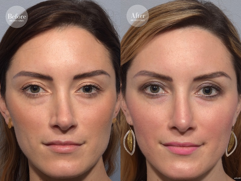 patient before and after revision rhinoplasty